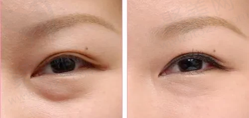 于建华做眼睛口碑怎么样
