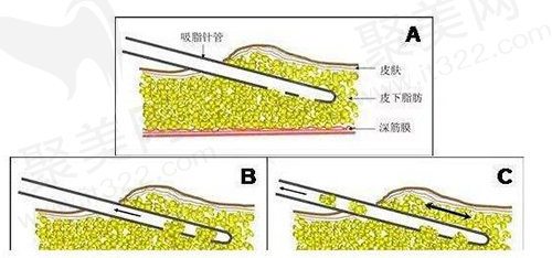 吸脂