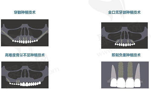 成都极光口腔种植牙技术