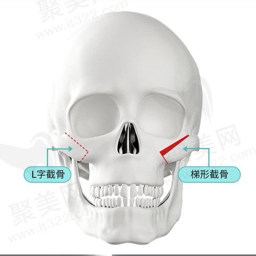 L字截骨/梯形截骨