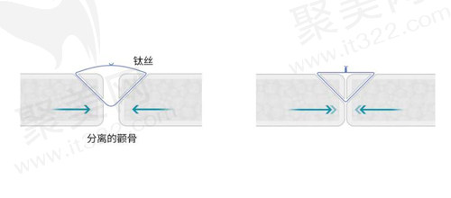 钛丝/分离的颧骨