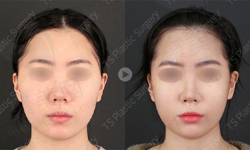 求美者做完轮廓缩小后正面术前后对比
