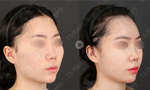 求美者做完轮廓缩小后45°术前后对比