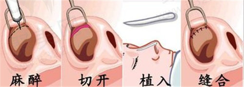隆鼻手术