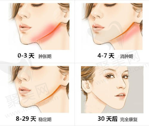 隆鼻手术