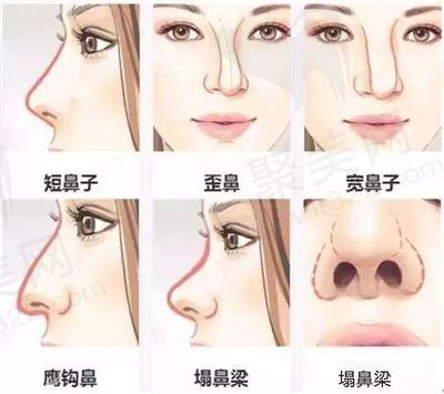 隆鼻手术
