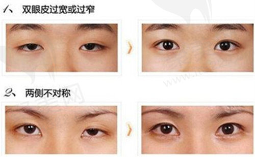 眼部修复