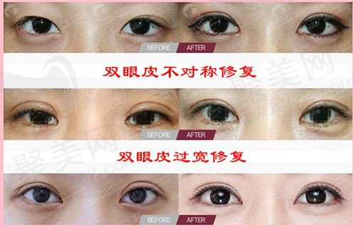 眼部修复
