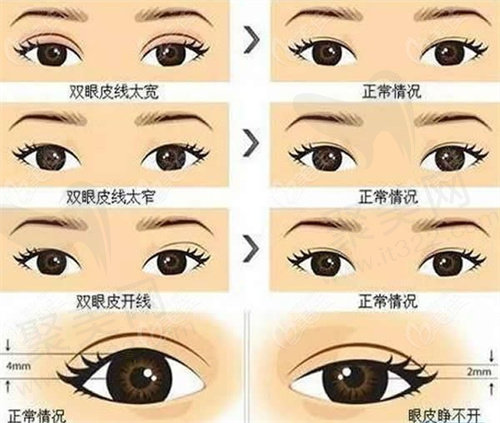 眼部修复