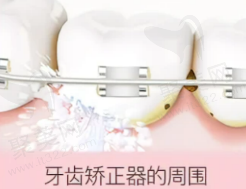 牙齿矫治器冲洗