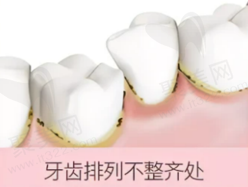牙齿不齐冲洗