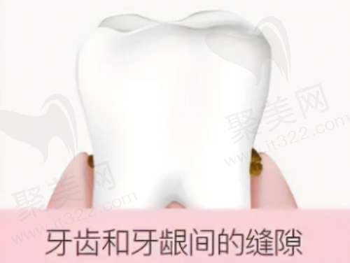 牙齿缝隙冲洗