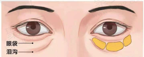 眼袋分类