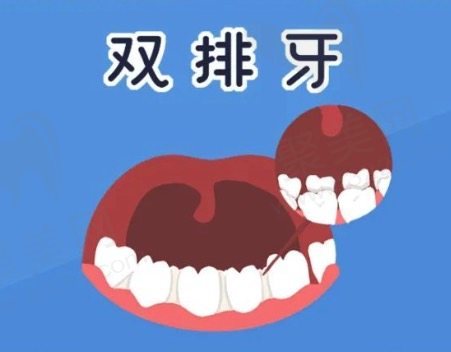 小孩为什么会长双排牙？