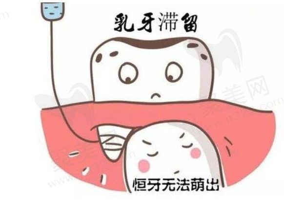 儿童双排牙什么时候拔比较好？