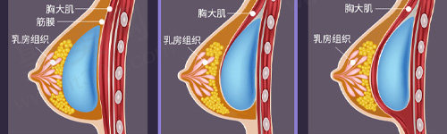 胸部整形时的方法方式