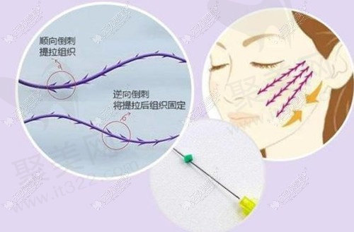 埋线提升