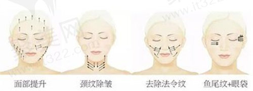埋线提升
