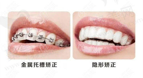 牙齿矫正