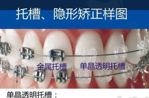 牙齿矫正