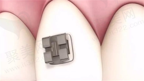 牙齿矫正