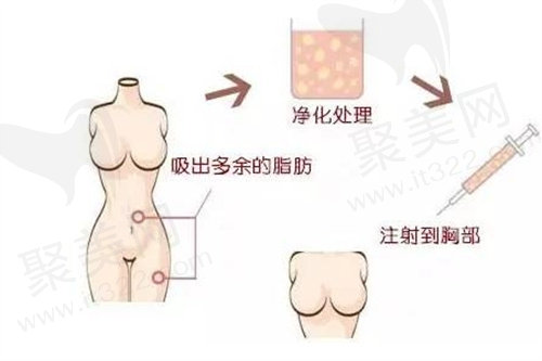 自体脂肪丰胸