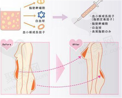 自体脂肪丰胸