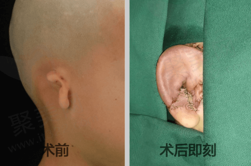 北京丽都整形郭志华耳再造