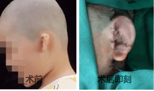 北京丽都整形郭志华耳再造