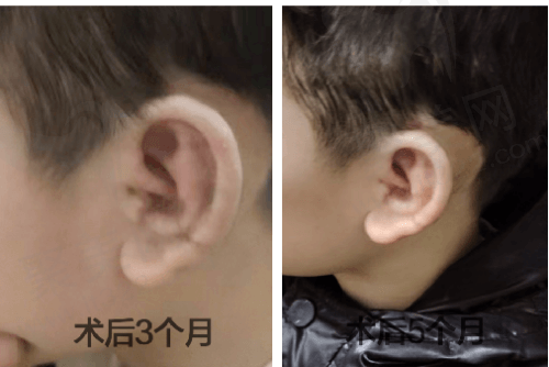 北京丽都整形郭志华耳再造