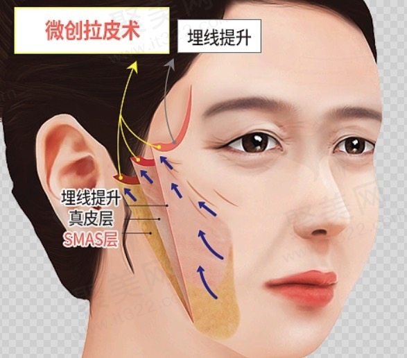 全脸拉皮除皱需要多少钱