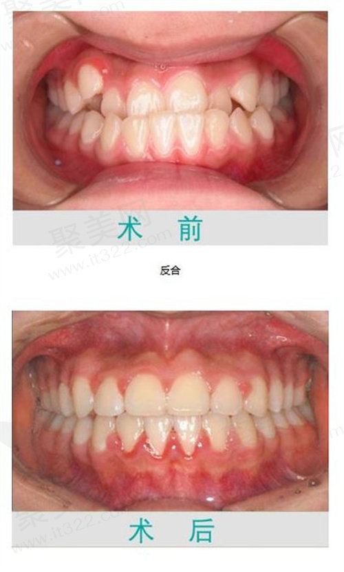 牙齿矫正