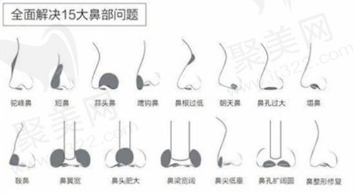 隆鼻
