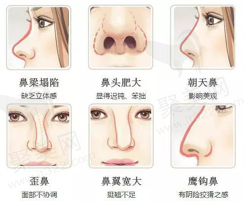隆鼻