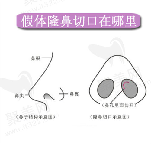 隆鼻