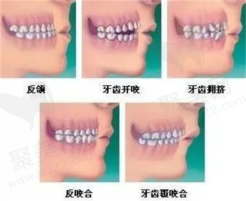 牙齿畸形