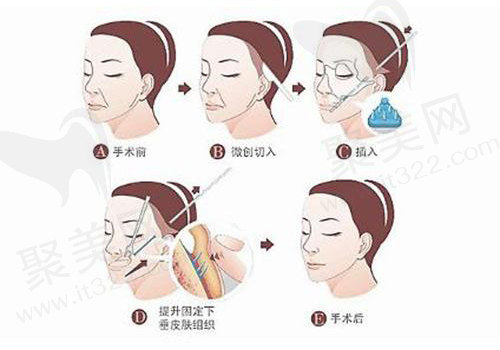 筋膜悬吊术方式步骤
