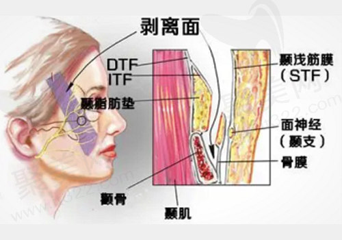 筋膜悬吊术的名称