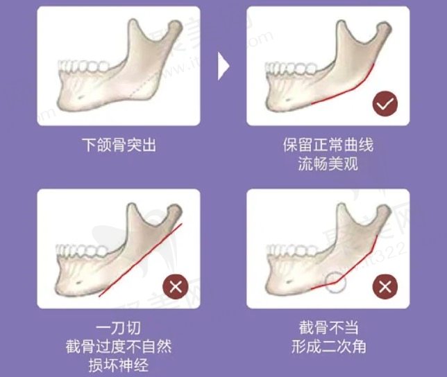 磨骨手术风险大吗？