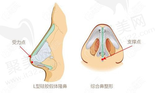 膨体隆鼻