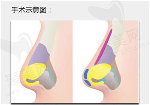 膨体隆鼻