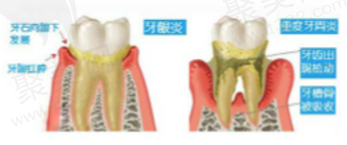牙周治疗有必要吗？