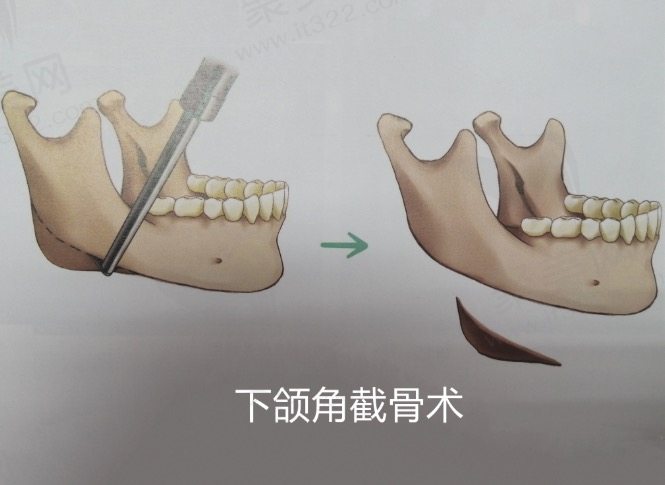 下颌角削骨十年后会有什么症状？