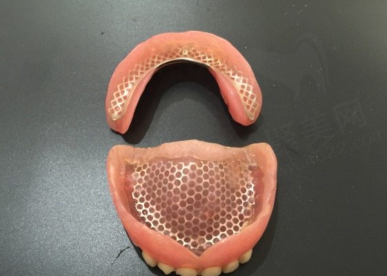 吸附性义齿修复全口缺牙