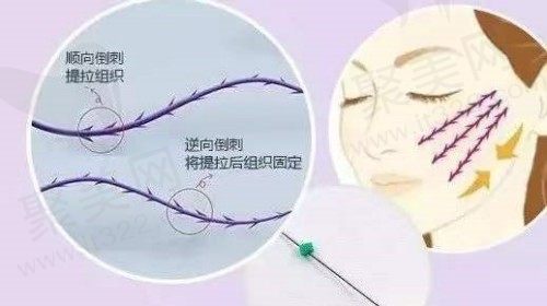 埋线提升紧致