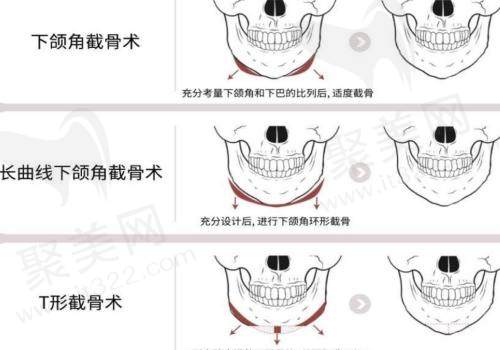 不同截骨手术