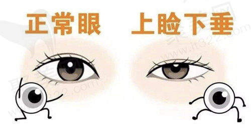 上眼睑下垂可以矫正吗