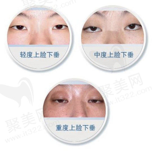 上眼睑下垂可以矫正吗