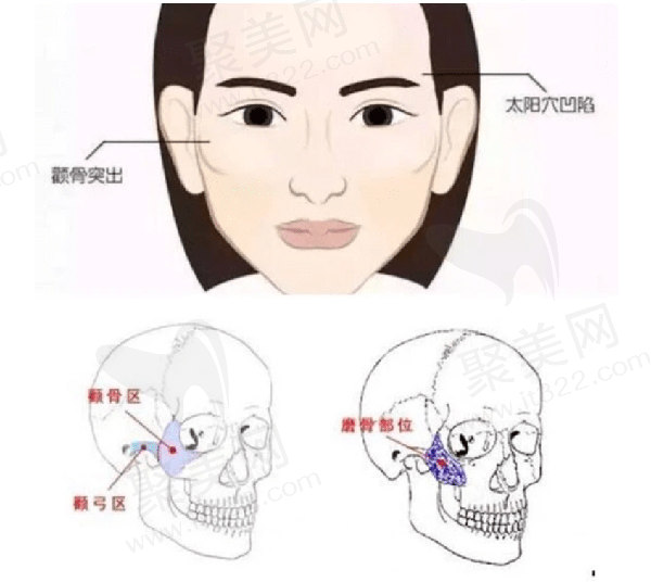北京何照华颧弓内推怎么样