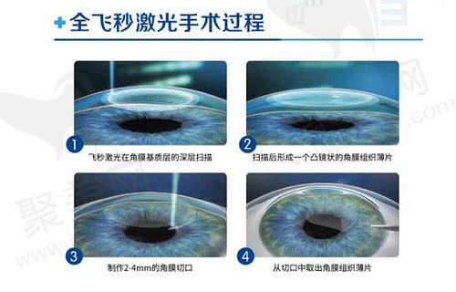 近视手术